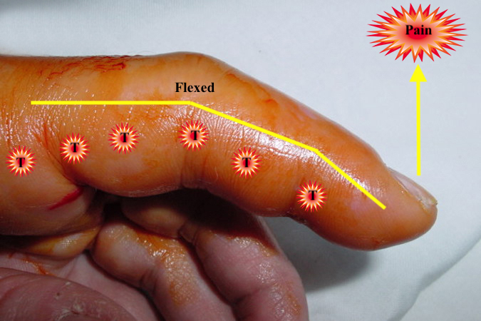 kanavel-s-sign-hand-surgery-source